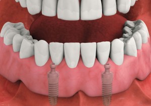 Woodyard Periodontics - Implant Supported Dentures