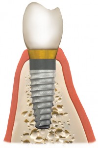 Woodyard Periodontics - Bone Grafts and Dental Implants